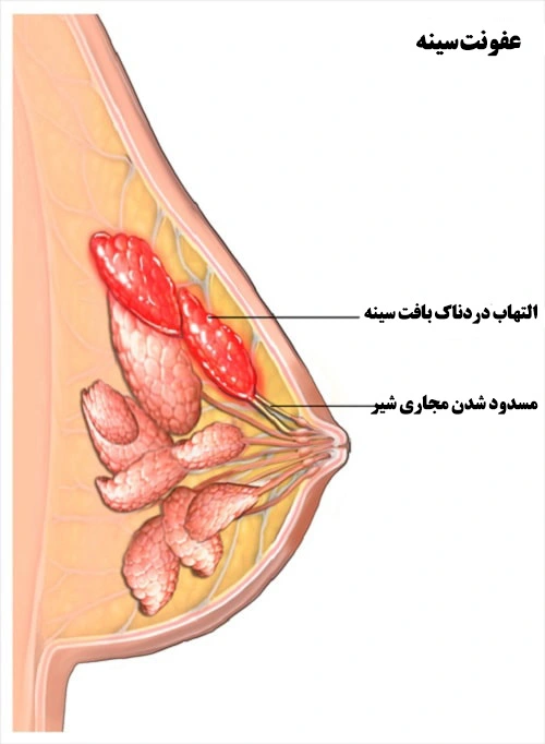 علل عفونت سینه