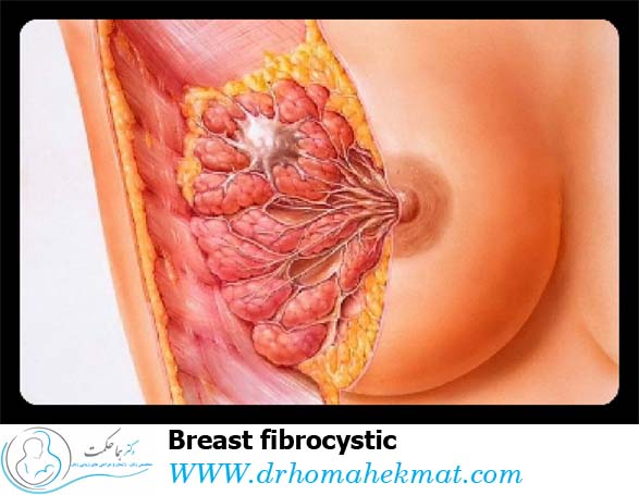 تغییرات فیبروکیست پستان